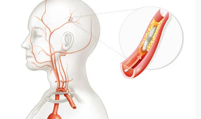 वर्ल्ड स्ट्रोक डे: 40 साल से कम उम्र के युवा सबसे ज्यादा स्ट्रोक के शिकार, खुद का ऐसे रखें ख्याल stroke- India TV Hindi