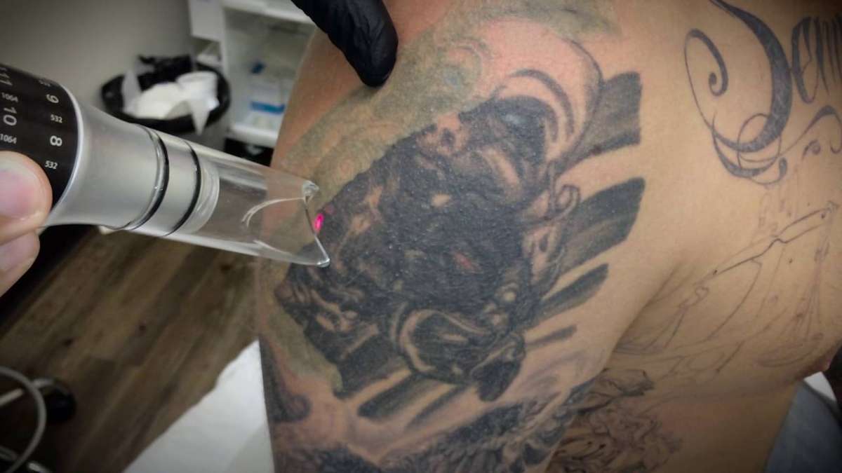 Laser Tattoo Removal Treatment in Manhattan - Sobel Skin