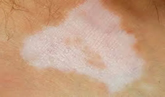 सफेद दाग से हैं परेशान तो उससे जुड़ी इन खास बातों को कभी न करें इग्नोर <p>skin care</p>- India TV Hindi
