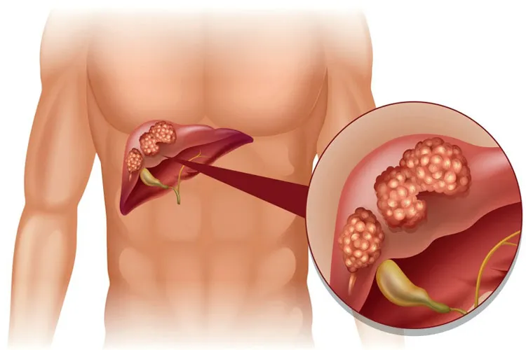 लीवर कैंसर होने के कारण, लक्षण और उपचार liver cancer- India TV Hindi