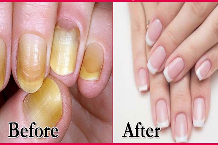 how To Whiten Your Nails With Toothpaste Toothpaste का करें यूं