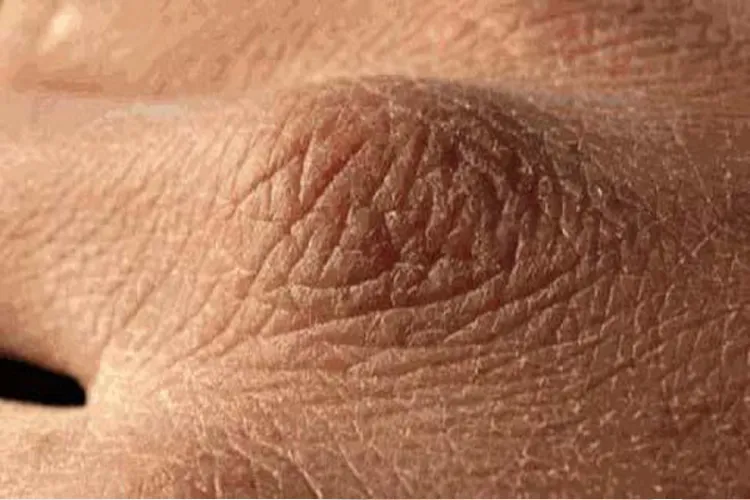 शरीर में पानी की कमी से होती हैं ये बीमारियां, न करें नजरअंदाज <p>skin problem</p>- India TV Hindi