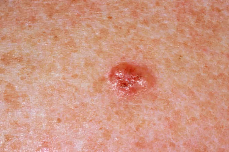 स्किन कैंसर के ये हैं छोटे-छोटे लक्षण जो आप अक्सर कर देते हैं इग्नोर <p>skin cancer</p>- India TV Hindi