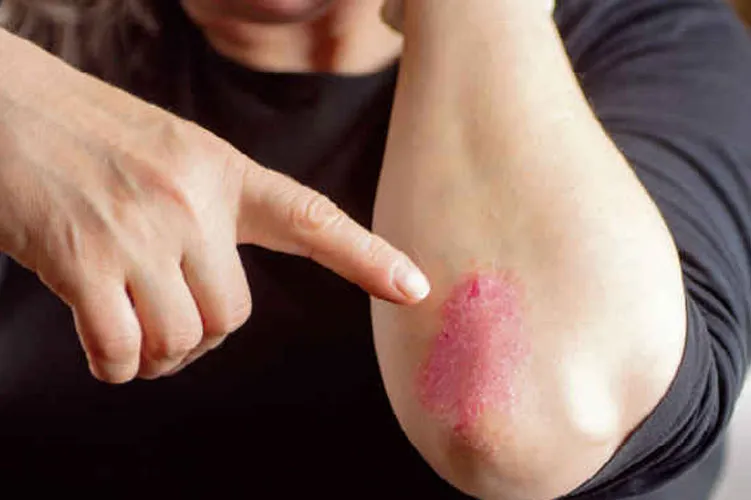 World Psoriasis Day : इन लोगों को सोराइसिस होने का खतरा सबसे अधिक, जानें लक्षण और बचाव psoriasis- India TV Hindi
