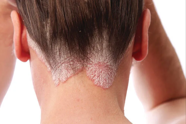 सर्दियों में सोरायसिस हो सकता है खतरनाक, ऐसे रखें खुद का ख्याल psoriasis- India TV Hindi