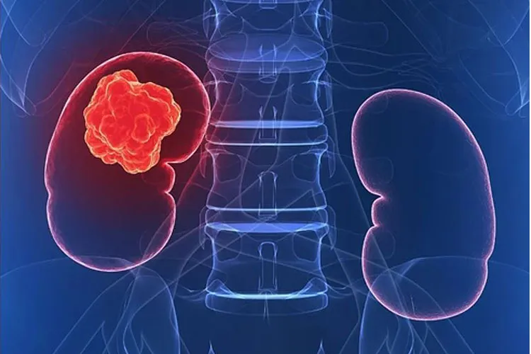 World Kidney Day 2019: अगर आपको दिखें यें संकेत, तो समझ लें कि आपको है किडनी कैंसर Kidney Cancer- India TV Hindi
