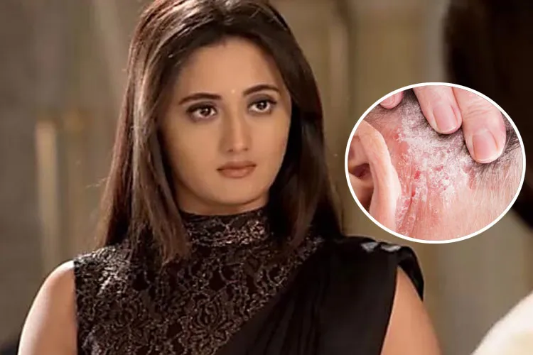 एक्ट्रेस रश्मि देसाई को हुआ था 'सोरायसिस', जानें इस रोग के बारे में सबकुछ Rashmi Desai, Psoriasis, - India TV Hindi