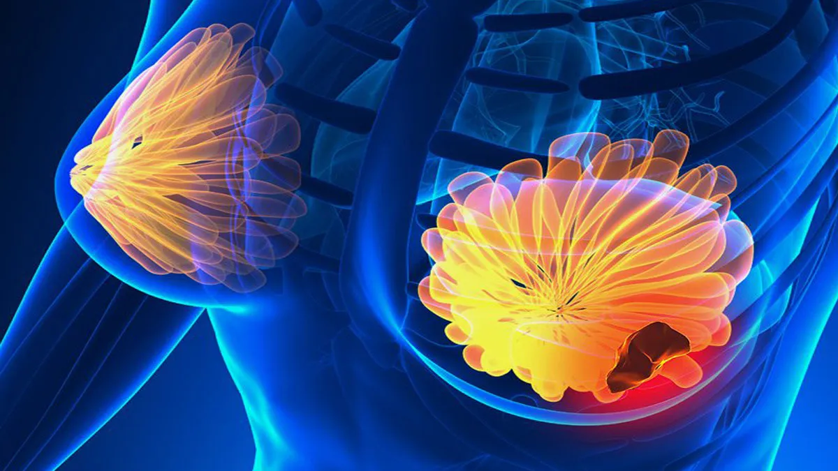 Breast Cancer: नार्मल से दिखने वाले इस संकेतों को न करें इग्नोर, हो सकता है ब्रेस्ट कैंसर Breast cancer- India TV Hindi