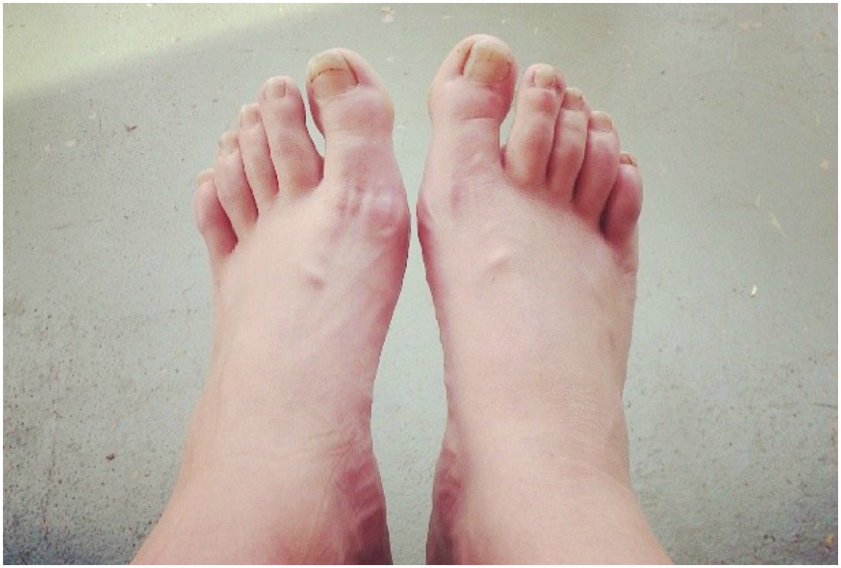 swollen legs or feet swelling during work from home try these home