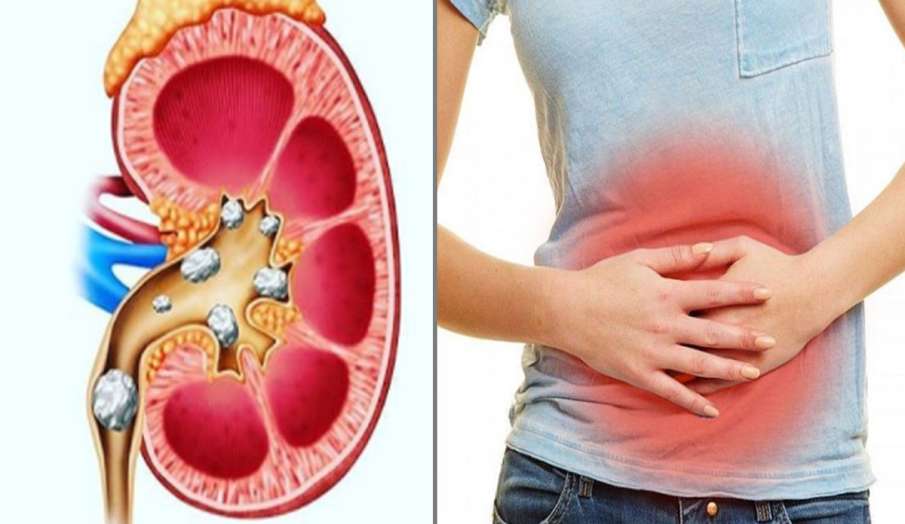 Home remedies for kidney stone or kidney me pathri swami ramdev share  ayurvedic home remedy to remove kidney stones naturally: पथरी से समस्या से  निजात पाने के लिए अपनाएं ये घरेलू नुस्खे,