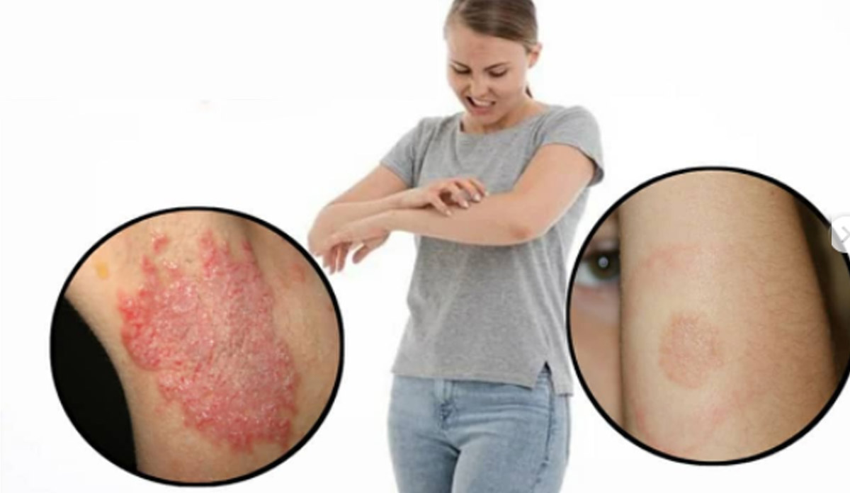 Home remedies for ringworm or dad khaj khujli know how to get rid of