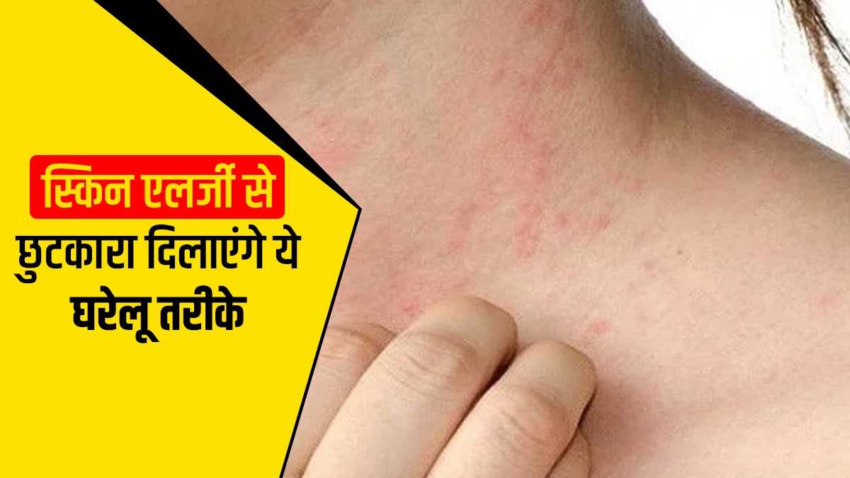 Skin care Tips in hindi to get rid of skin allergies naturally Skin