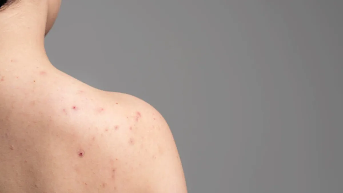 पीठ और कंधे पर निकल आए हैं दाने? अपनाएं ये घरेलू उपाय, दाग भी हो जाएंगे गायब back acne- India TV Hindi
