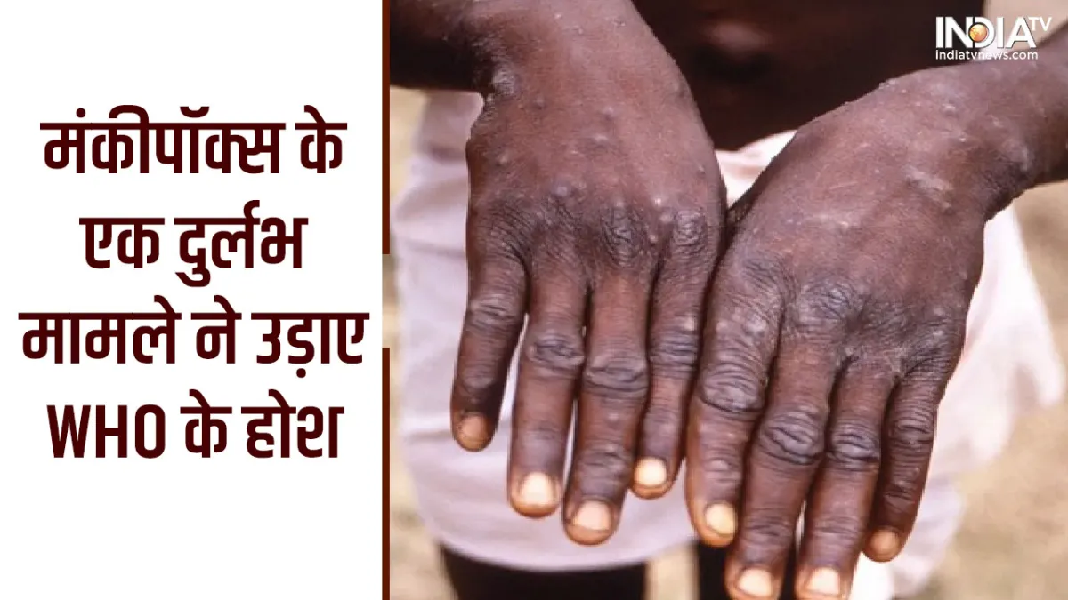 Monkeypox News: मंकीपॉक्स का अनोखा केस सामने आया, इंसान के संपर्क में आने से कुत्ता संक्रमित, WHO ने दी ये सलाह Monkeypox- India TV Hindi