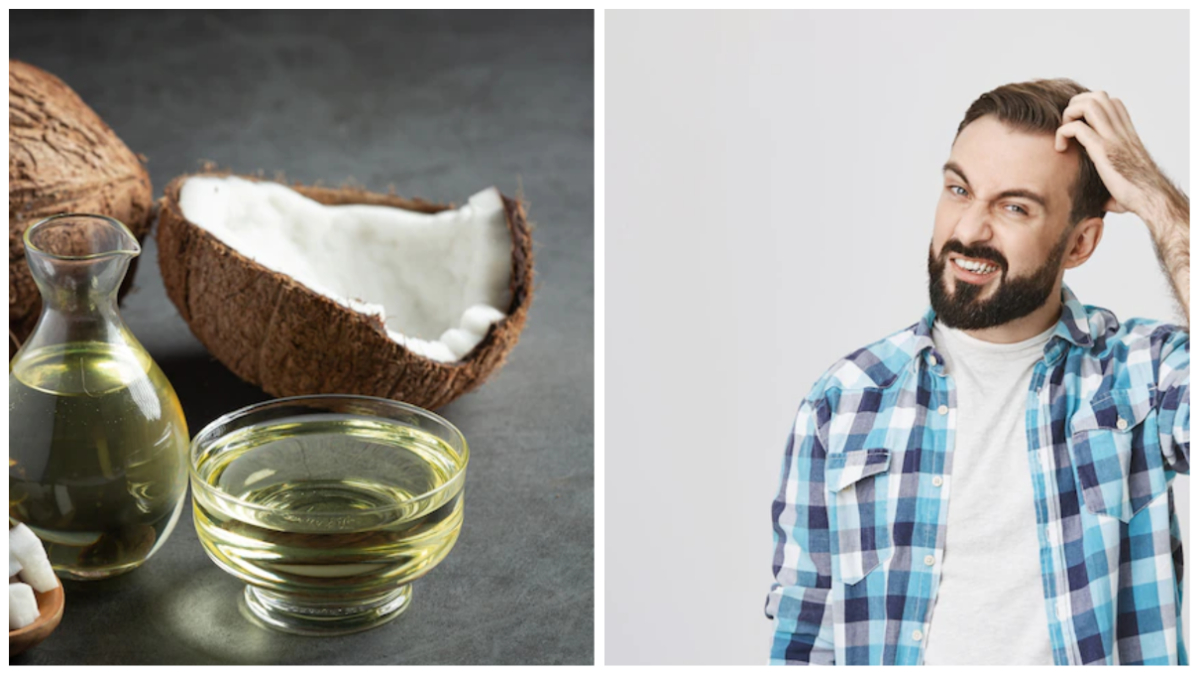 सर्दियों में डैंड्रफ और झड़ते बालों के लिए नारियल तेल के फायदे