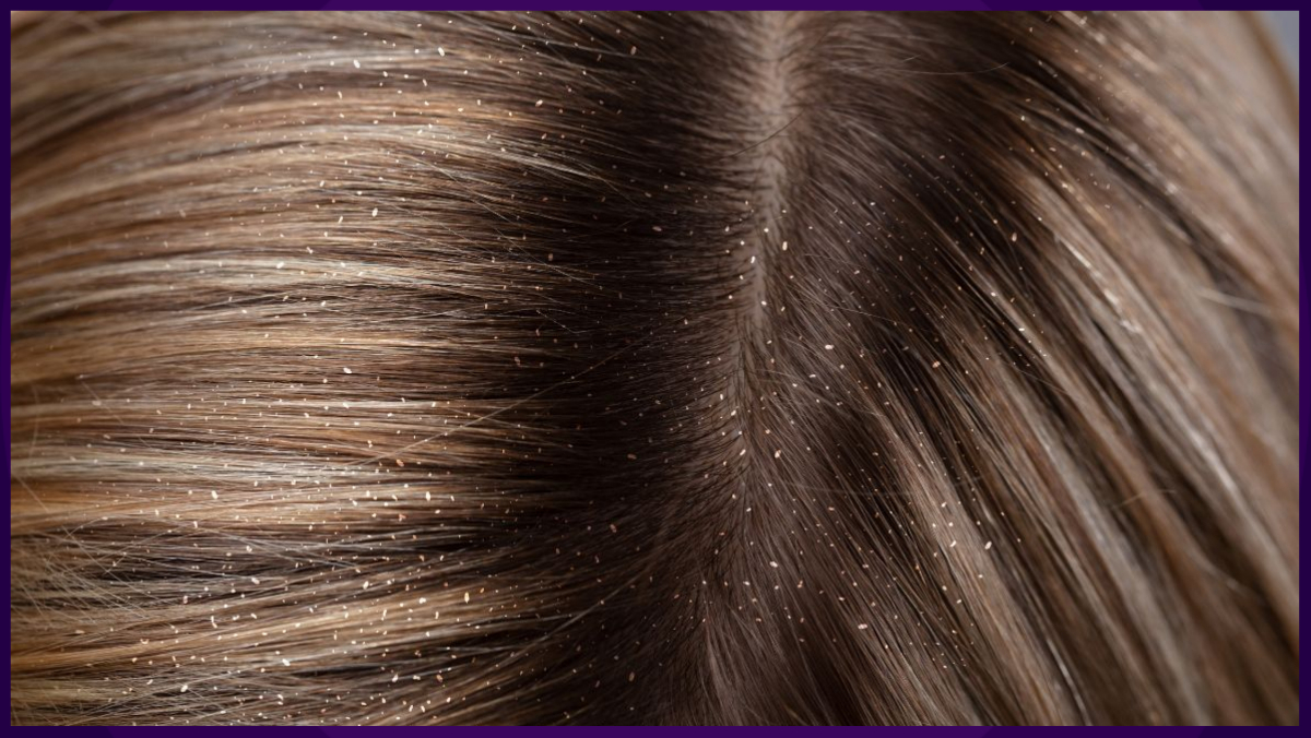 Hair Dandruff: सर्दी में डैंड्रफ की समस्या से हैं परेशान? ये 5 घरेलू नुस्खे दूर करेंगे आपकी टेंशन