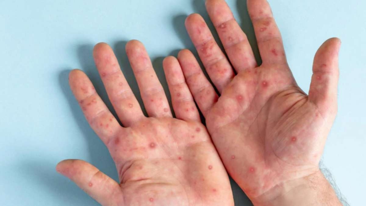 अब नए नाम से जाना जाएगा Monkeypox, WHO ने किया ऐलान World Health organization recommend new name of monkeypox called it mpox