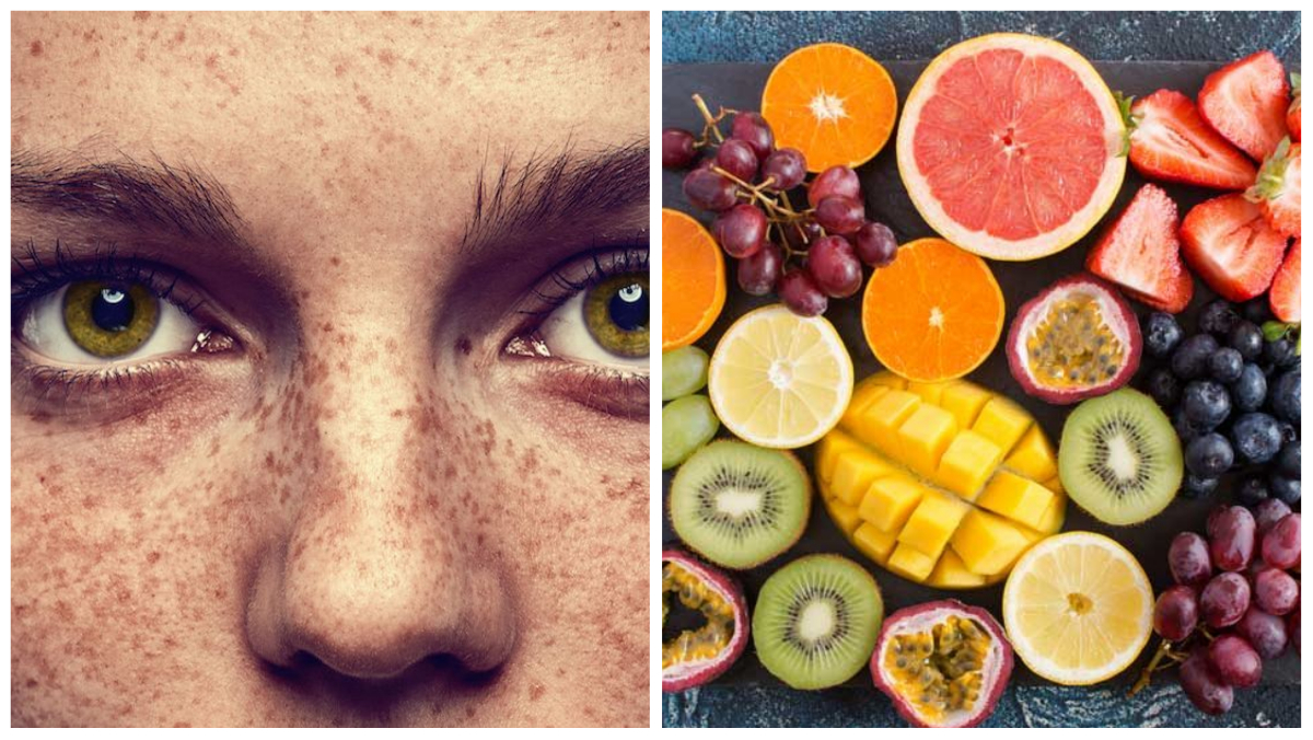 Jhaiyon ka ilaaj: झाइयां हटाने के लिए क्या खाएं | Foods to avoid freckles in hindi