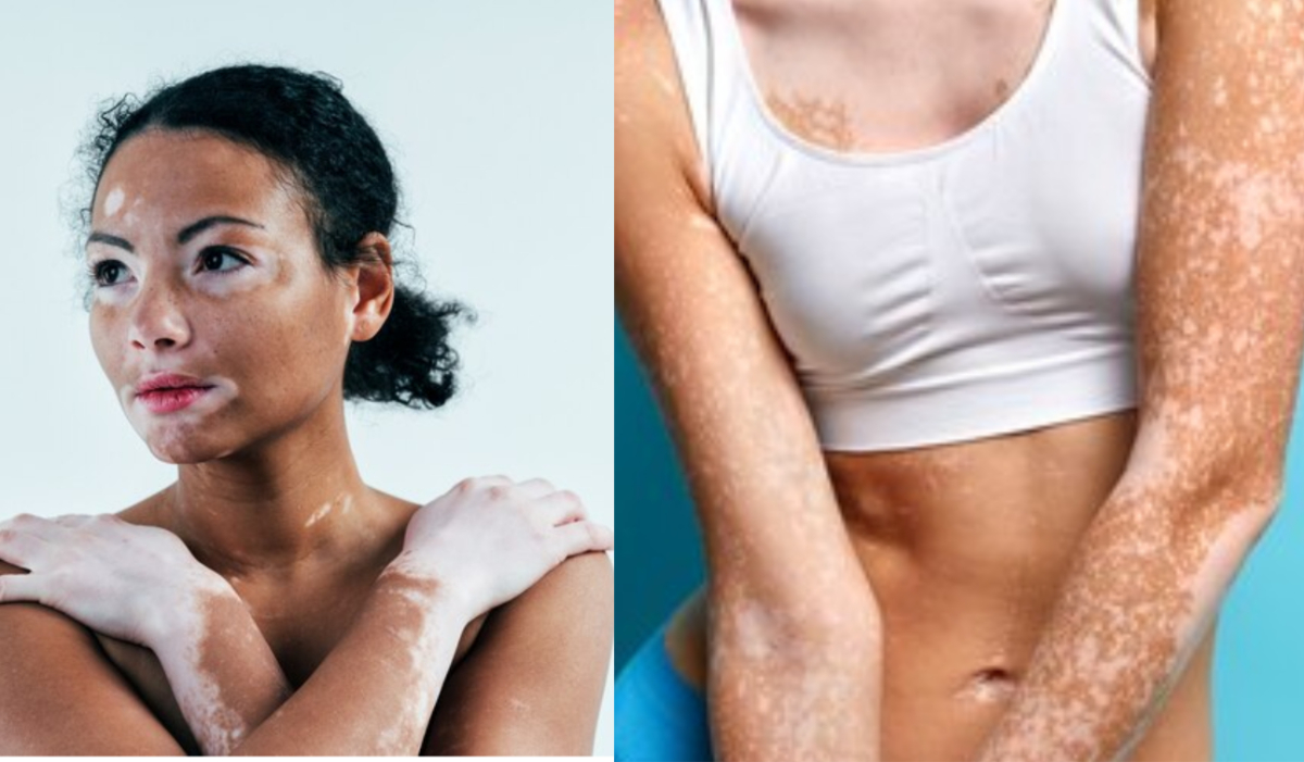 how to get rid of vitiligo, vitiligo myth, Safed daag ke lakshan नॉनवेज या बैंगन खाने के बाद दूध पीने से क्या सच में हो जाता है सफेद दाग (vitiligo), जानिए क्या कहती है रिसर्च?