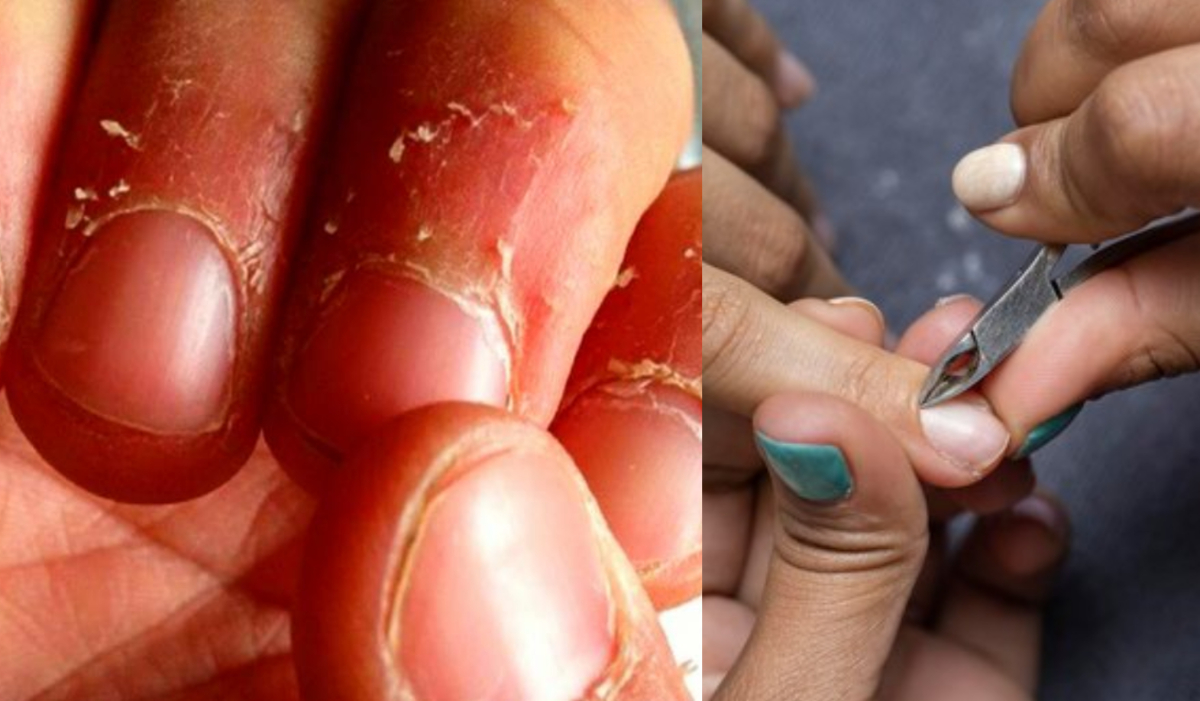 5 Essential Tips to Prevent and Heal Peeling Skin Around Your Nails -  VANCHIER