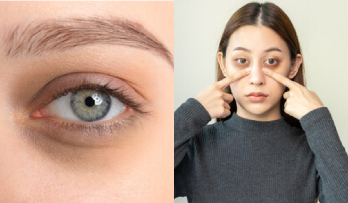 reason of Bags under eyes and mild swelling or puffiness under the eyes