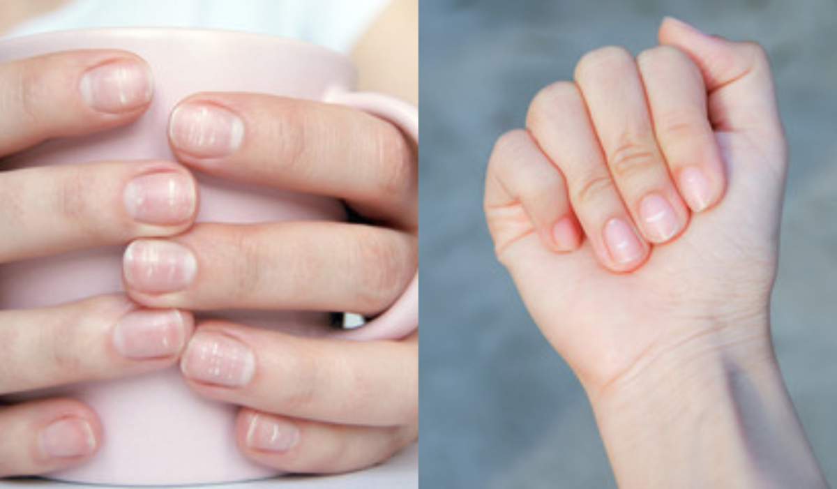 क्या आपके नाखून में भी है ये सफेद वाला निशान! जानिए ये आपकी हेल्थ के बारे  में क्या बताता है? | Know About white spot on nails and what leukonychia  tell about