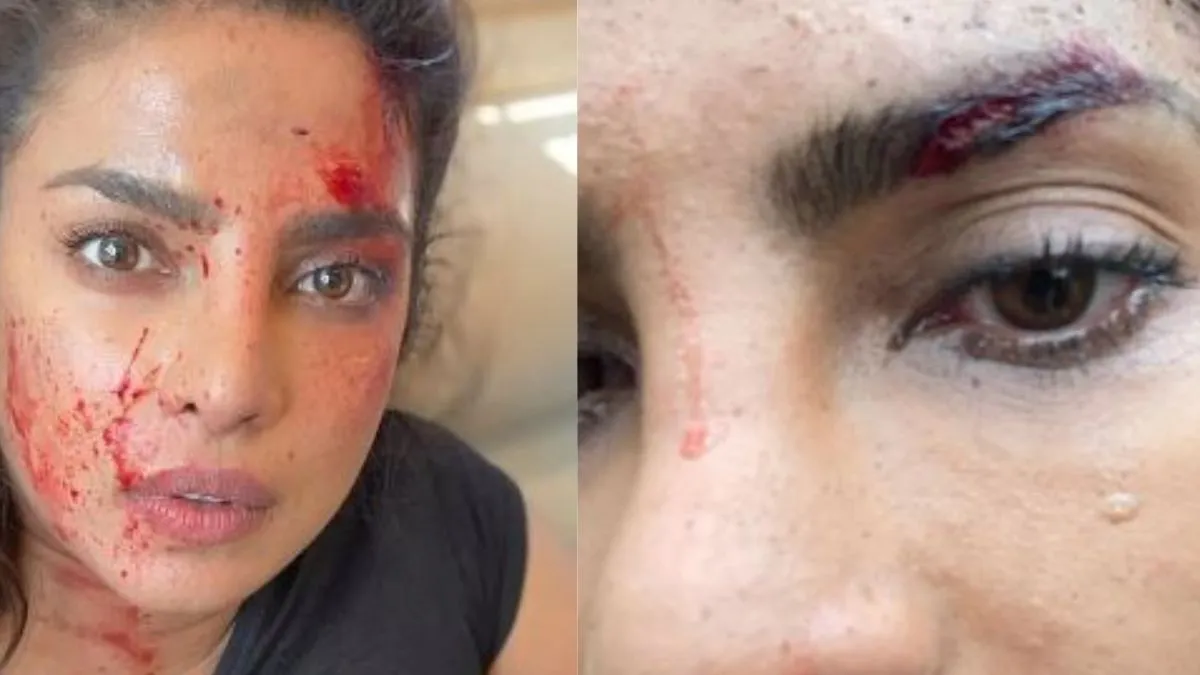 Priyanka Chopra हुई घायल? शेयर किया खून और चोट के निशान का वीडियो priyankachopra instagram- India TV Hindi
