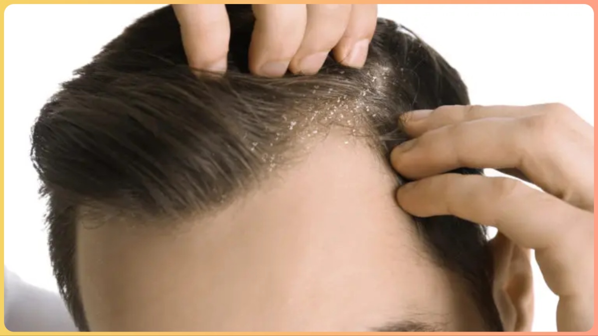 There will be a holiday of repeatedly troubling dandruff!  Try this remedy told by Jawed Habib