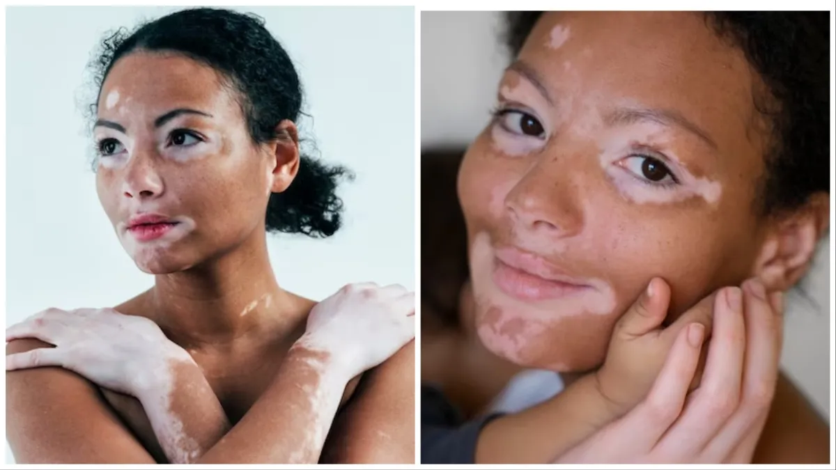 World Vitiligo Day: सफेद दाग (विटिलिगो) क्या है? कारण, लक्षण समेत जानें कितनी गंभीर है ये बीमारी vitiligo- India TV Hindi