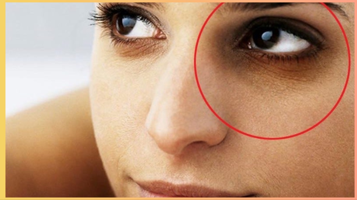 How to reduce dark circles and wrinkles under the eyes?  Know 3 effective tips