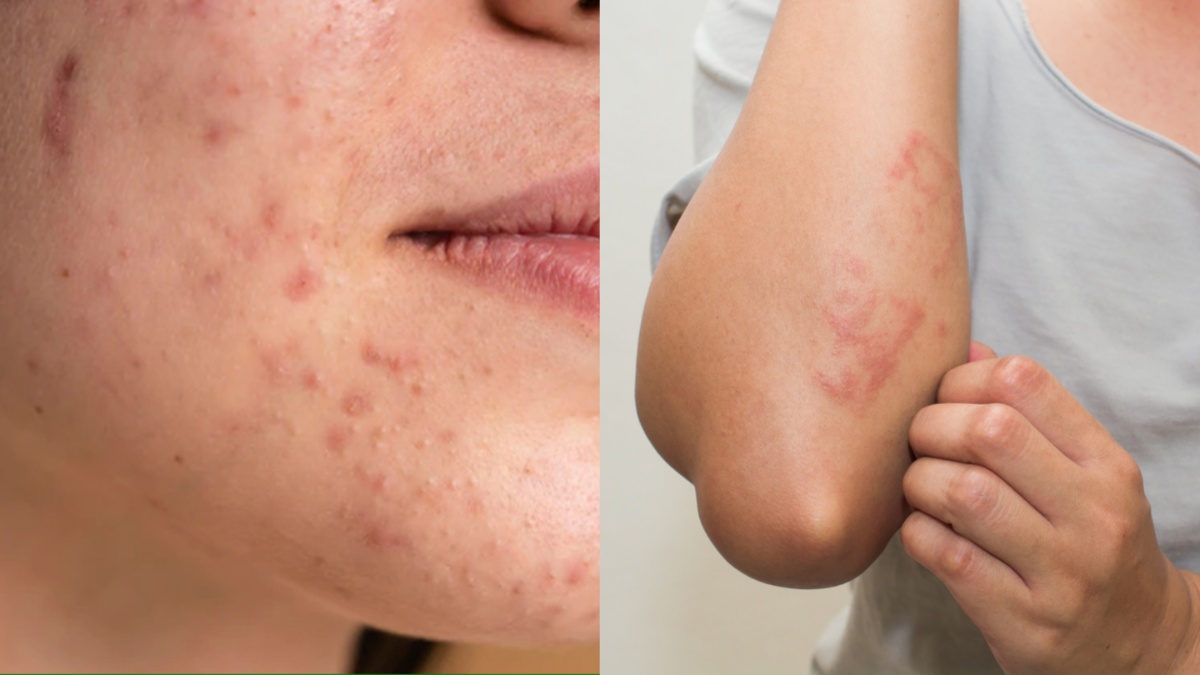 These remedies are effective in getting rid of skin allergies and rashes, you will get relief as soon as you try them – News