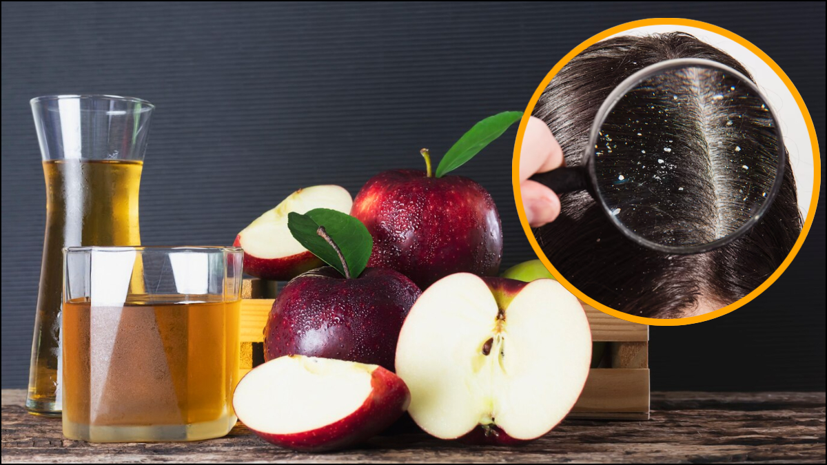 Unique treatment for dandruff problem, use apple cider vinegar in hair like this.