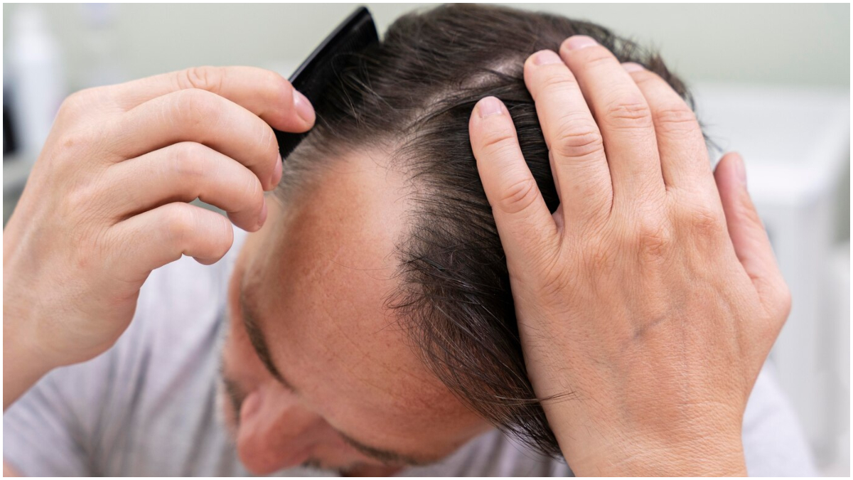 Constant hair fall should not become the cause of baldness!  Make hair strong by eating 4 things