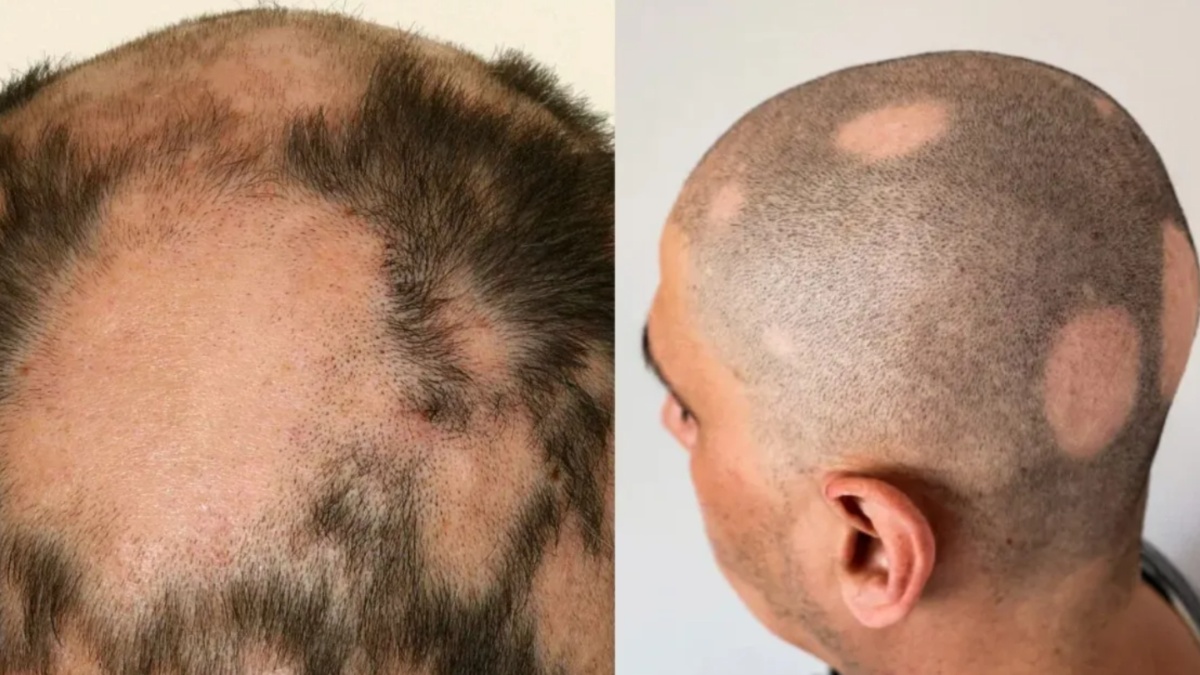 आपके सिर से भी निकल रहा है बालों का गुच्छा…कहीं आप भी तो नहीं Alopecia के शिकार; जानें लक्षण और बचाव के उपाय?