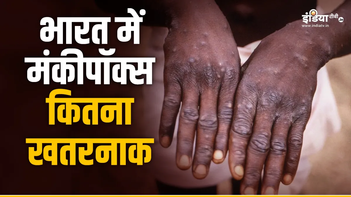 भारत में मंकीपॉक्स कितना खतरनाक है? अपने देश में दे चुका है दस्तक, सरकारें हुईं अलर्ट भारत में मंकीपॉक्स- India TV Hindi