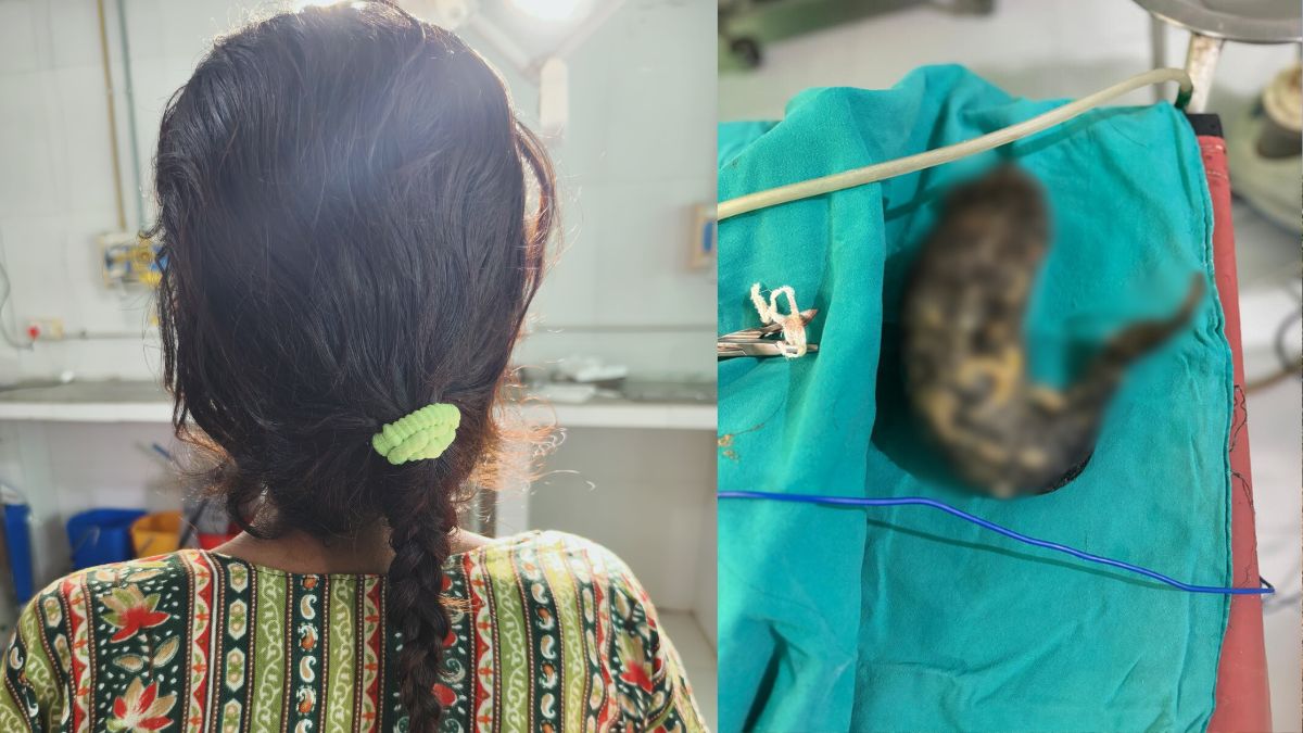 16 सालों से अपने ही सिर के बाल खा रही थी युवती, डॉक्टरों ने ऑपरेशन कर पेट से निकाला बालों का गुच्छा