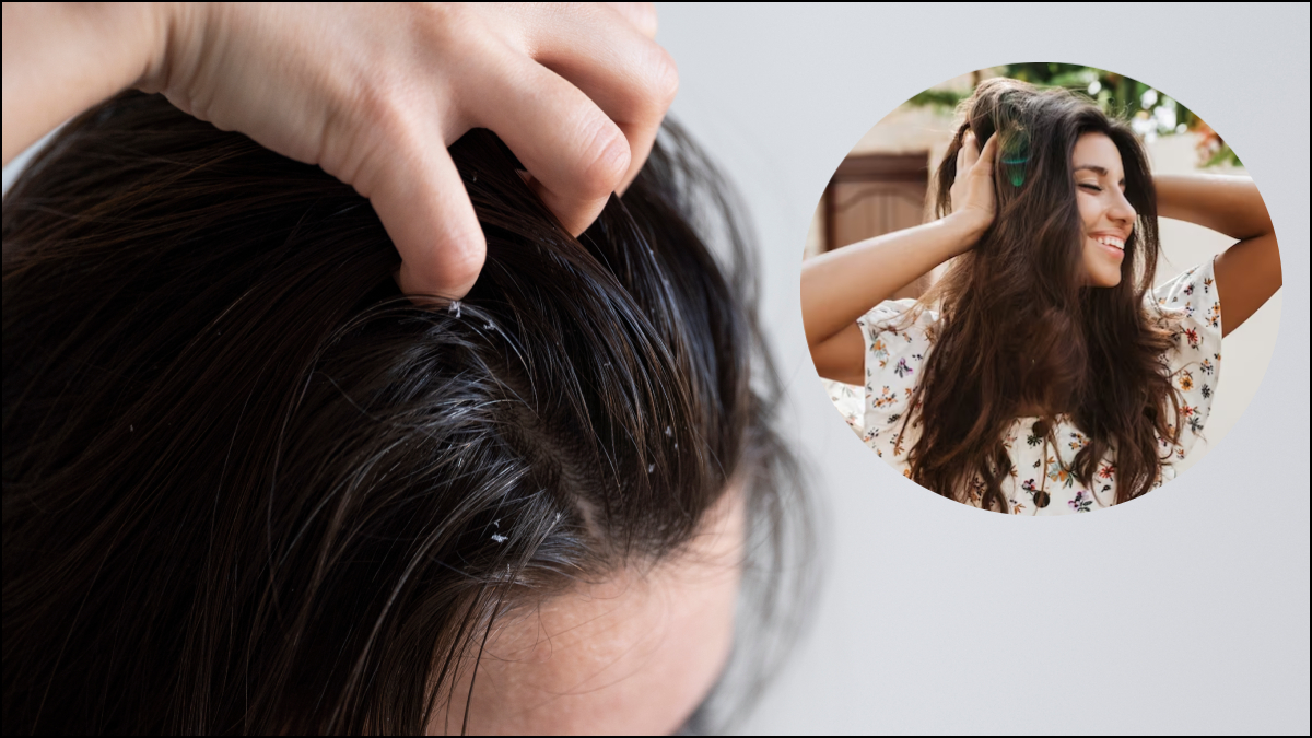 सिर में खुजली, डैंड्रफ और बालों के झड़ने से परेशान हैं, जान लें इसके कारण और कैसे पाएं इस समस्या से छुटकारा