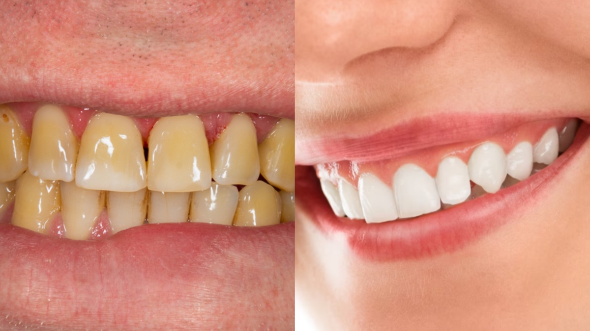 नमक और सरसों के तेल से चमक जाएंगे पीले दांत, ज़िद्दी प्लाक की भी होगी छुट्टी, जानें कैसे करें इस्तेमाल?