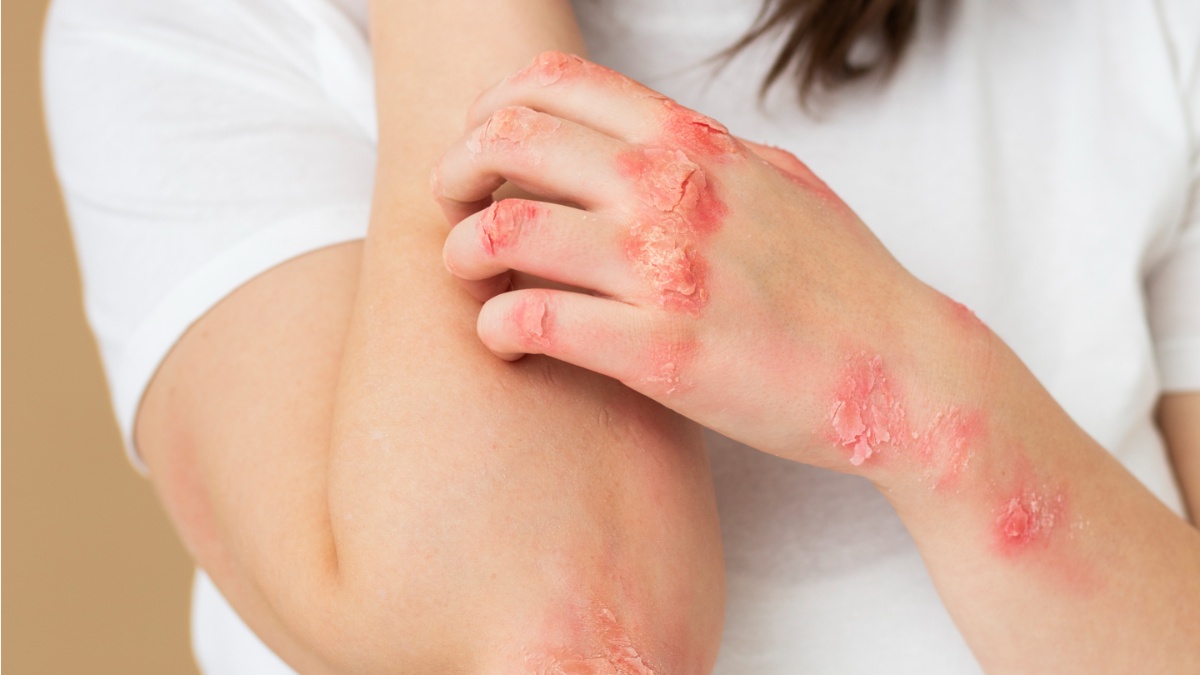 डॉक्टर से जानें किन कारणों से होता है सोरायसिस, क्या हैं इसके लक्षण और बचाव के उपाय