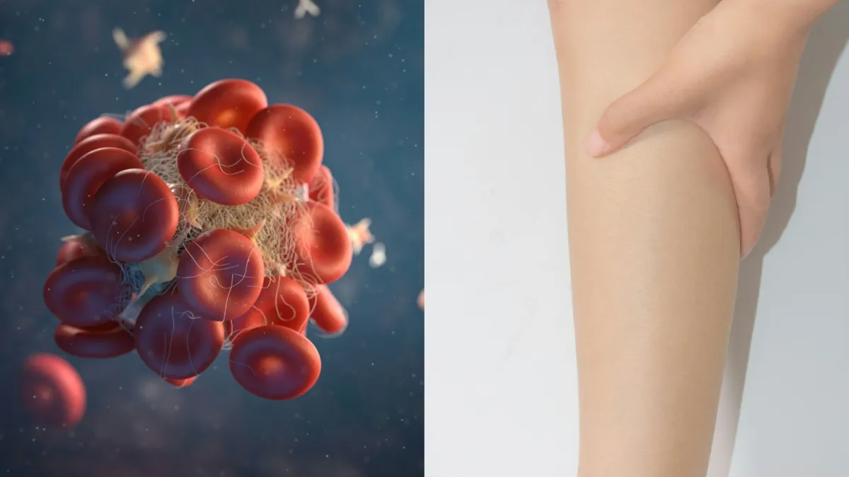 World Thrombosis Day: पैरों में रहने लगी है सूजन, दर्द से हो गए हैं परेशान, कहीं हो तो नहीं गई ये गंभीर बीमारी थ्रोम्बोसिस - India TV Hindi