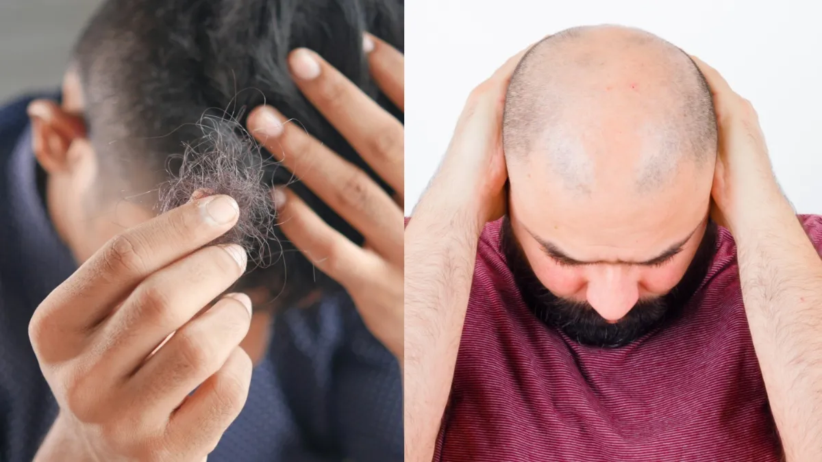 कौन-कौन सी मेडिकल कंडीशन बाल झड़ने का कारण बन सकती हैं? बता रहे हैं एक्सपर्ट बाल झड़ने का रीजन - India TV Hindi