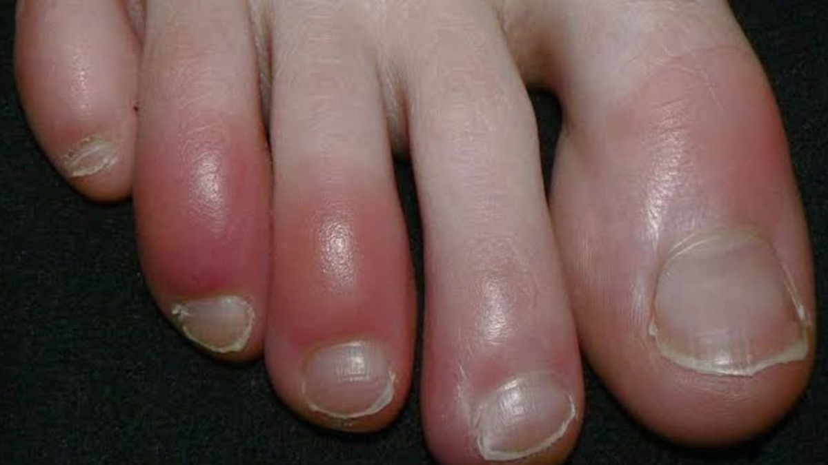 सर्दियों में पैर की उंगलियों में सूजन किस विटामिन की कमी से आती है? पैरों की सूजन खत्म करने के उपाय क्या हैं?