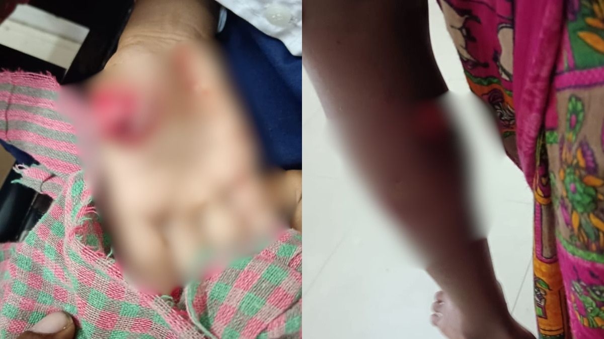शौचालय जाते छात्र पर टूट पड़ा आवारा कुत्ता, उंगली काटी; हाथ और पैर भी नोंचा