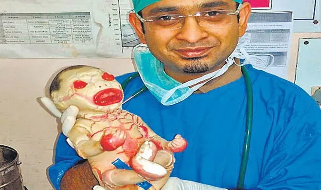  harlequin baby in nagpur- India TV Hindi