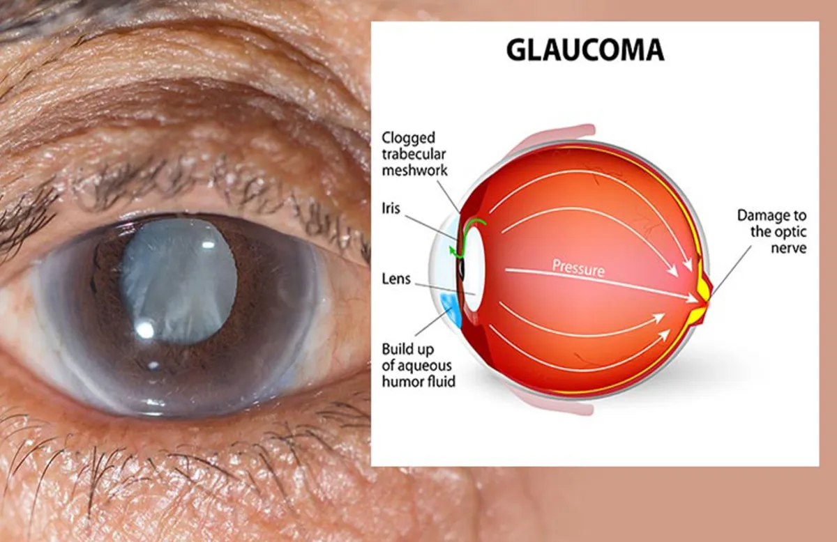 glaucoma
- India TV Hindi