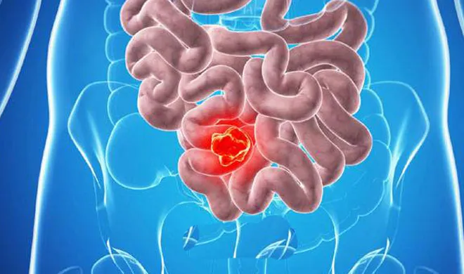 cancer- India TV Hindi