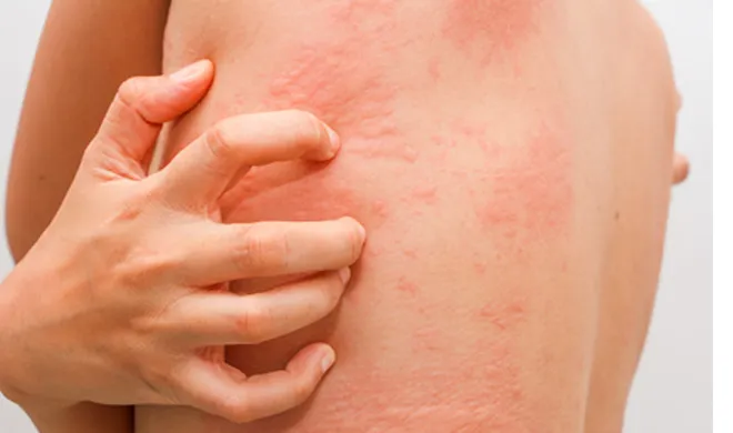 skin infection- India TV Hindi