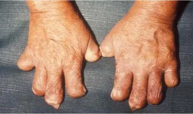 Leprosy Symptoms- India TV Hindi