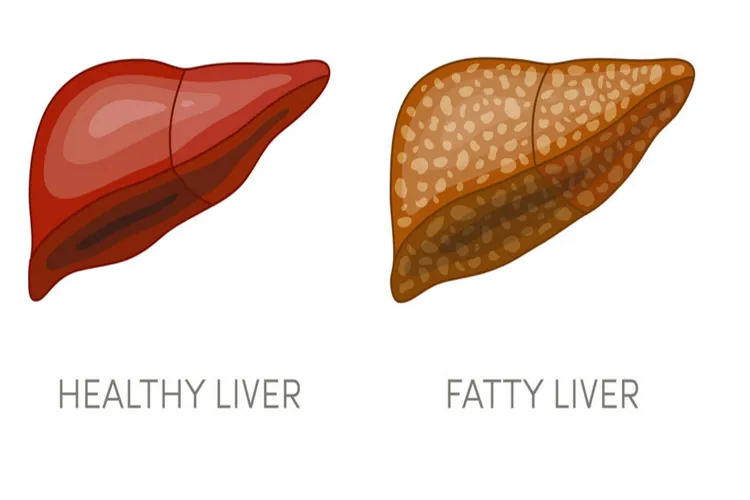 Fatty liver- India TV Hindi