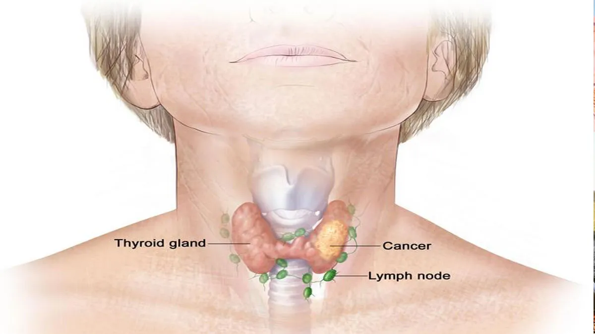 thyroid cancer- India TV Hindi